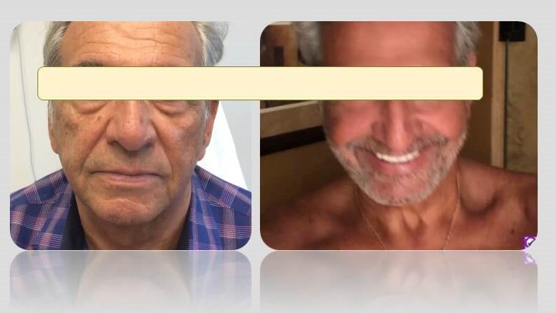 Dr. Suzman Fat Grafting and Na